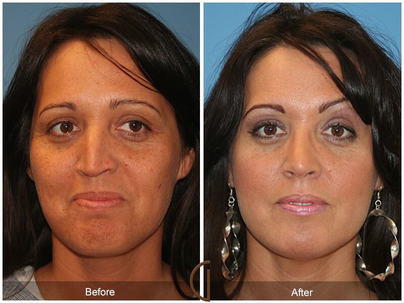 Female Rhinoplasty Before & After Photo