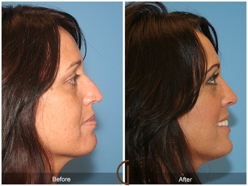 Female Rhinoplasty Before & After Photo