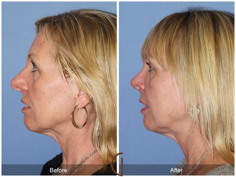 Female Rhinoplasty Before & After Photo