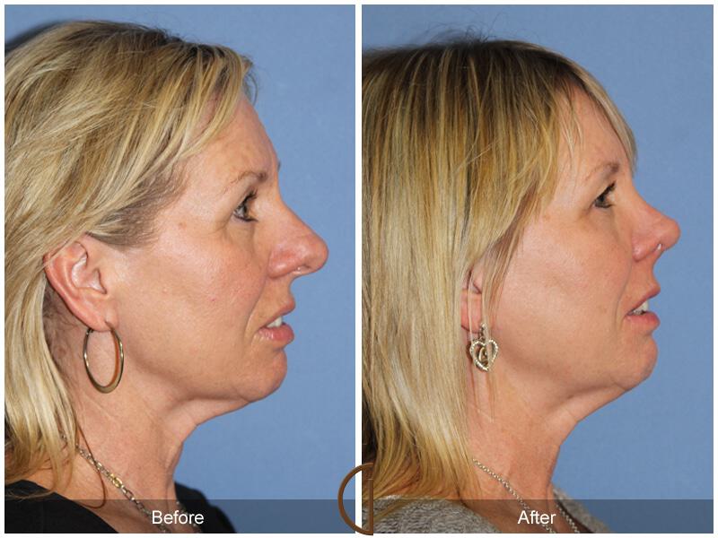 Female Rhinoplasty Before & After Photo