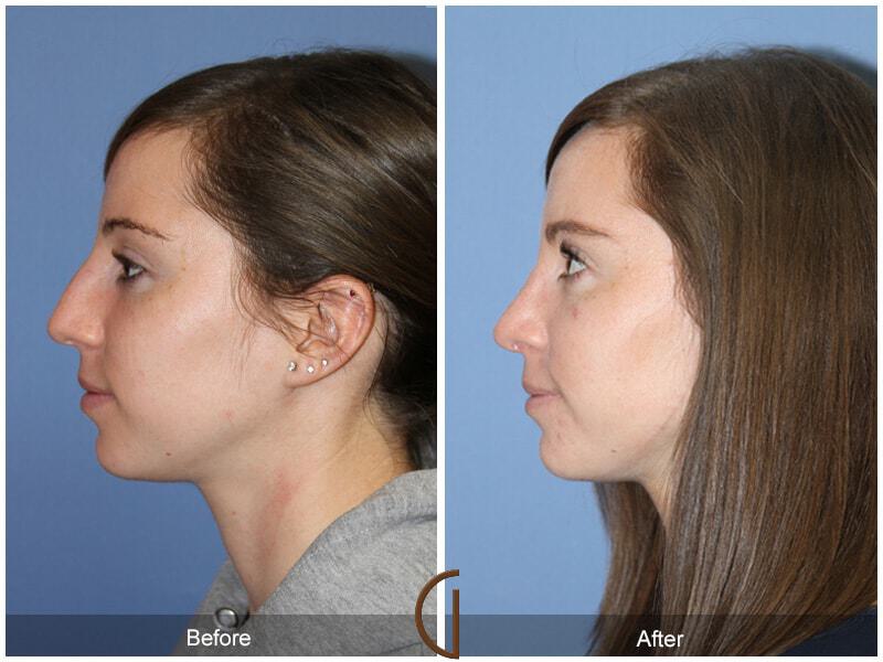 Female Rhinoplasty Before & After Photo