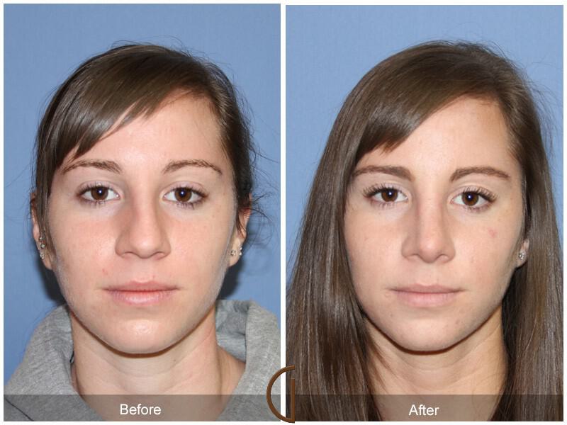 Female Rhinoplasty Before & After Photo