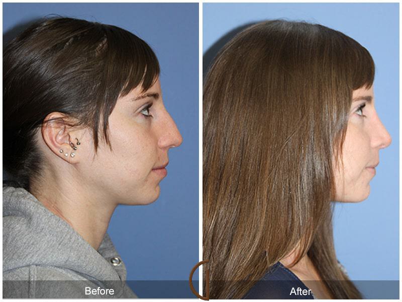 Female Rhinoplasty Before & After Photo