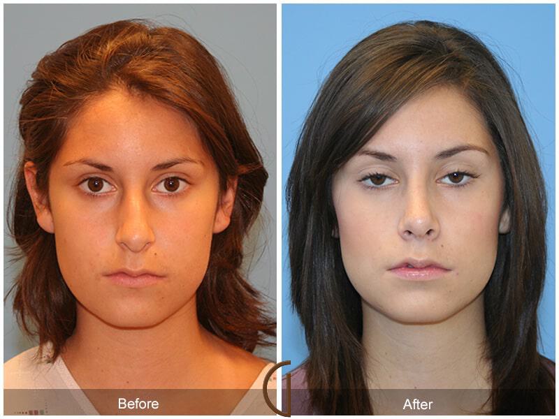 Female Rhinoplasty Before & After Photo