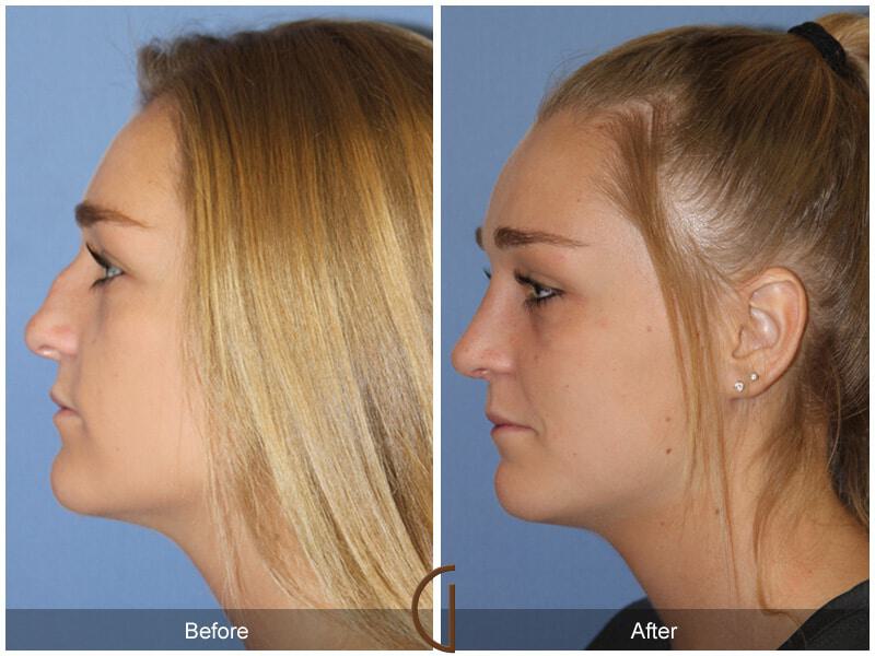 Female Rhinoplasty Before & After Photo