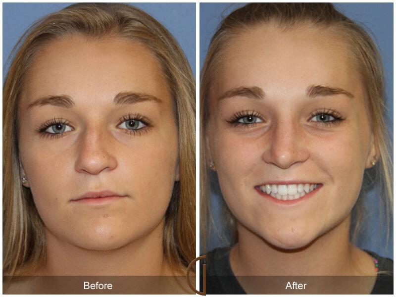 Female Rhinoplasty Before & After Photo