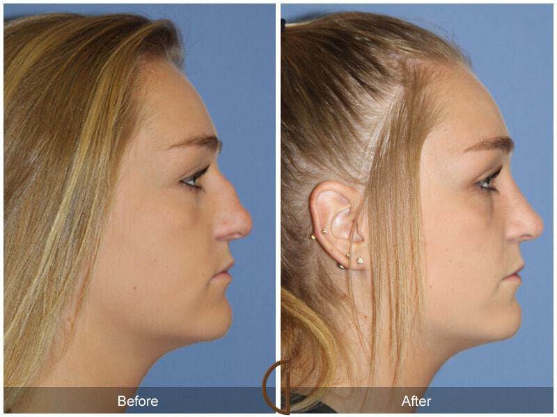 Female Rhinoplasty Before & After Photo