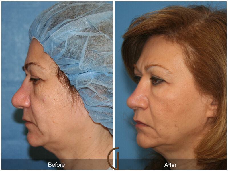 Female Rhinoplasty Before & After Photo