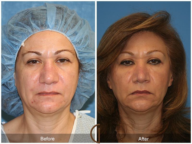 Female Rhinoplasty Before & After Photo