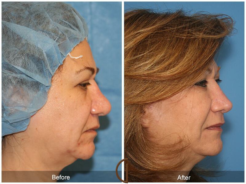 Female Rhinoplasty Before & After Photo