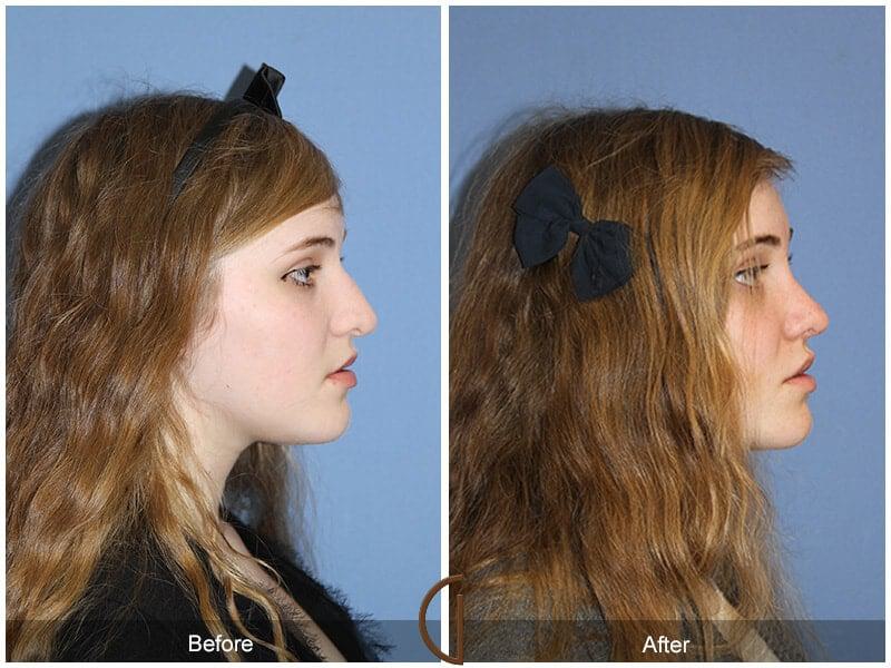 Female Rhinoplasty Before & After Photo