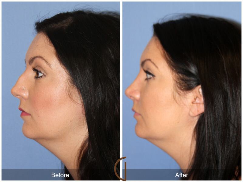 Female Rhinoplasty Before & After Photo