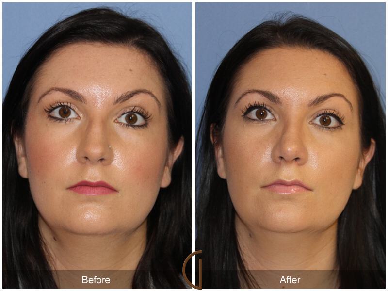 Female Rhinoplasty Before & After Photo