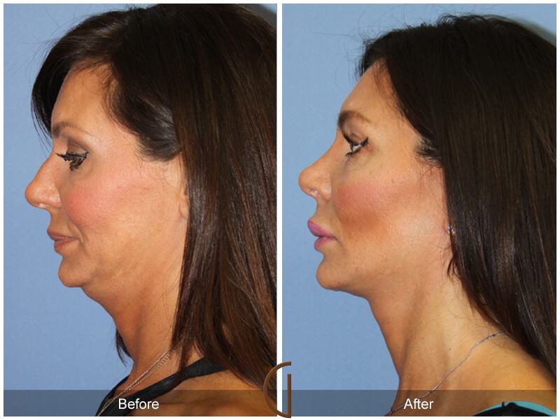 Female Rhinoplasty Before & After Photo