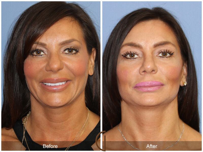 Female Rhinoplasty Before & After Photo