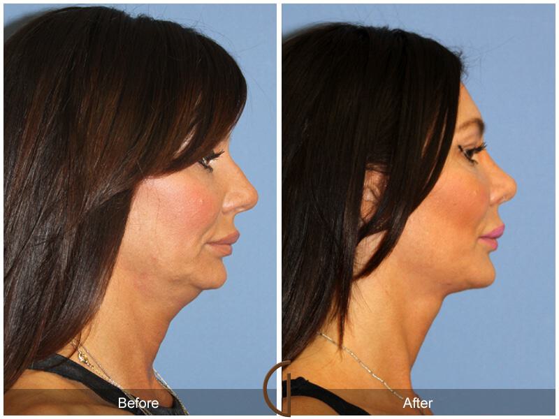 Female Rhinoplasty Before & After Photo