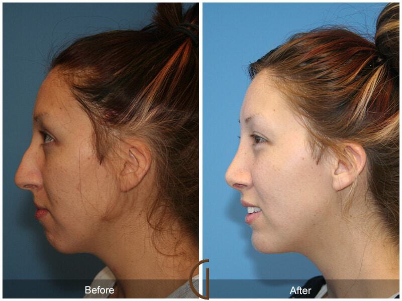 Female Rhinoplasty Before & After Photo