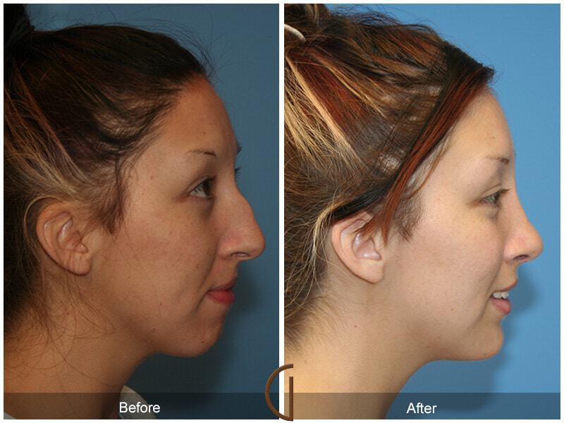 Female Rhinoplasty Before & After Photo