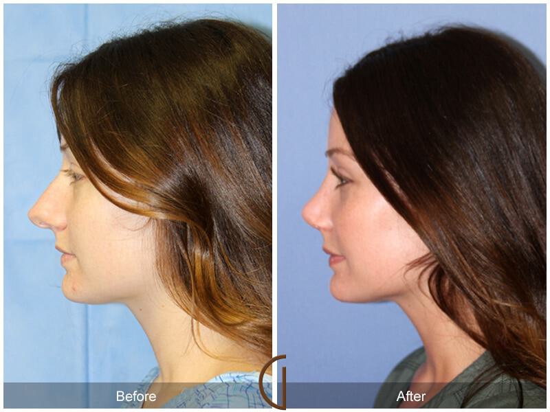 Female Rhinoplasty Before & After Photo