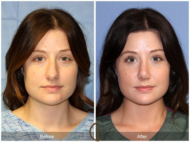 Female Rhinoplasty Before & After Photo