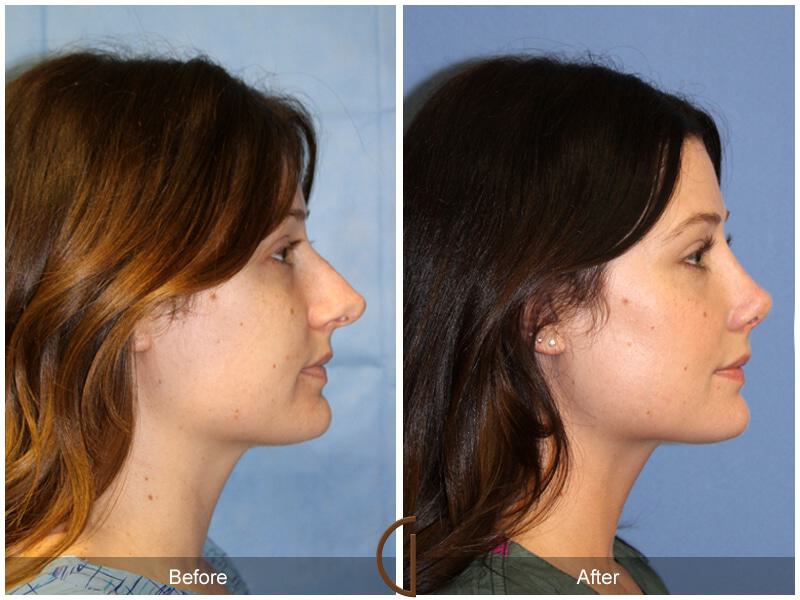 Female Rhinoplasty Before & After Photo