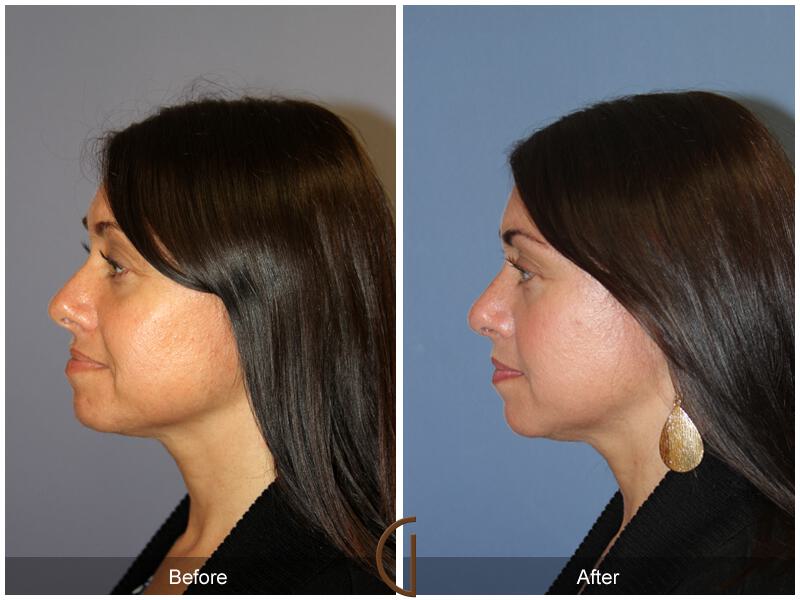 Female Rhinoplasty Before & After Photo