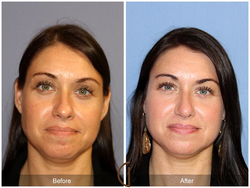 Female Rhinoplasty Before & After Photo