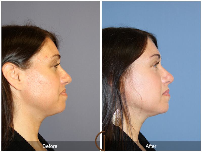 Female Rhinoplasty Before & After Photo