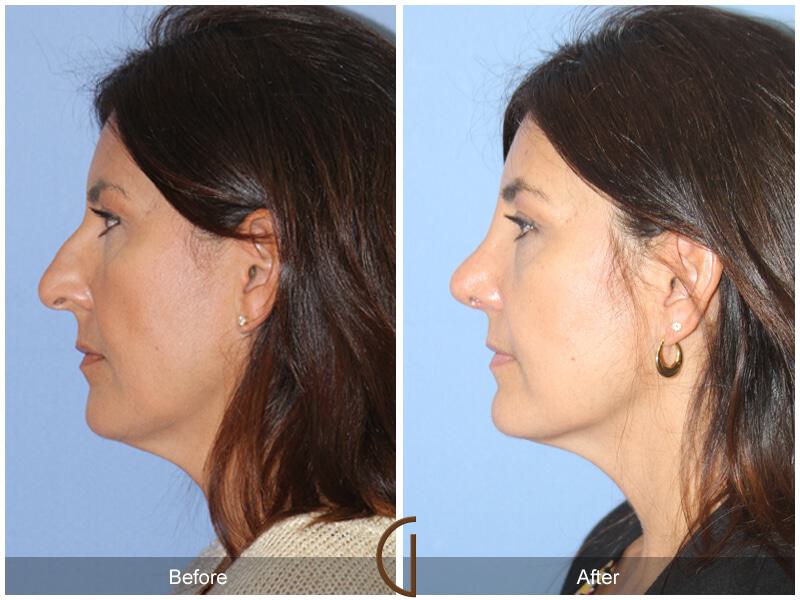 Female Rhinoplasty Before & After Photo