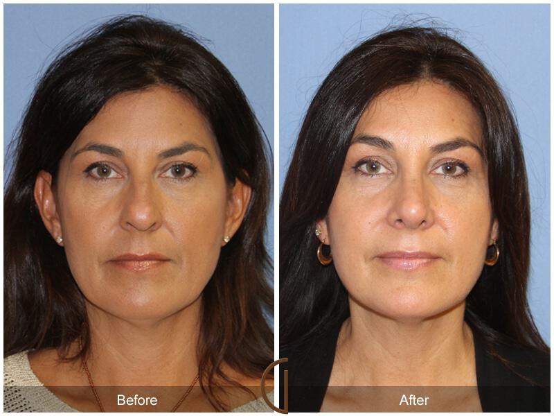 Female Rhinoplasty Before & After Photo