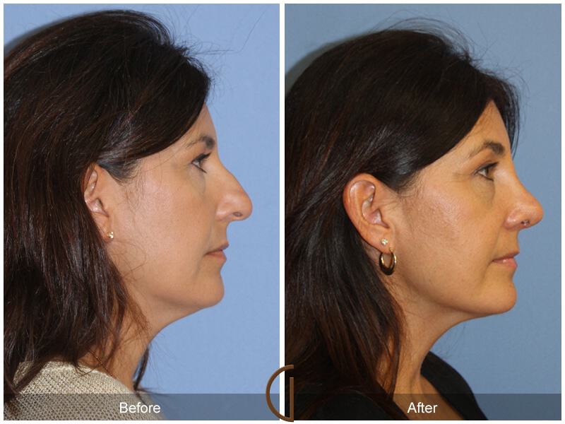 Female Rhinoplasty Before & After Photo