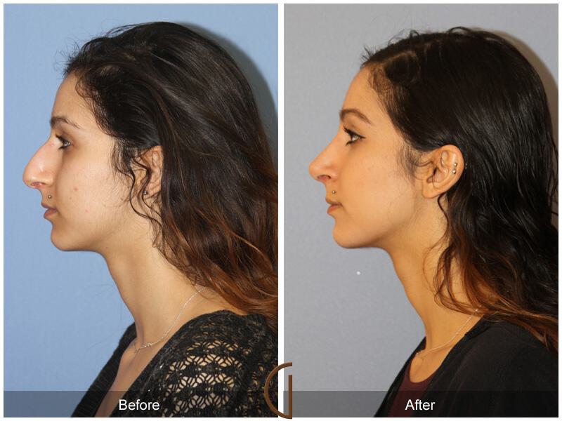 Female Rhinoplasty Before & After Photo