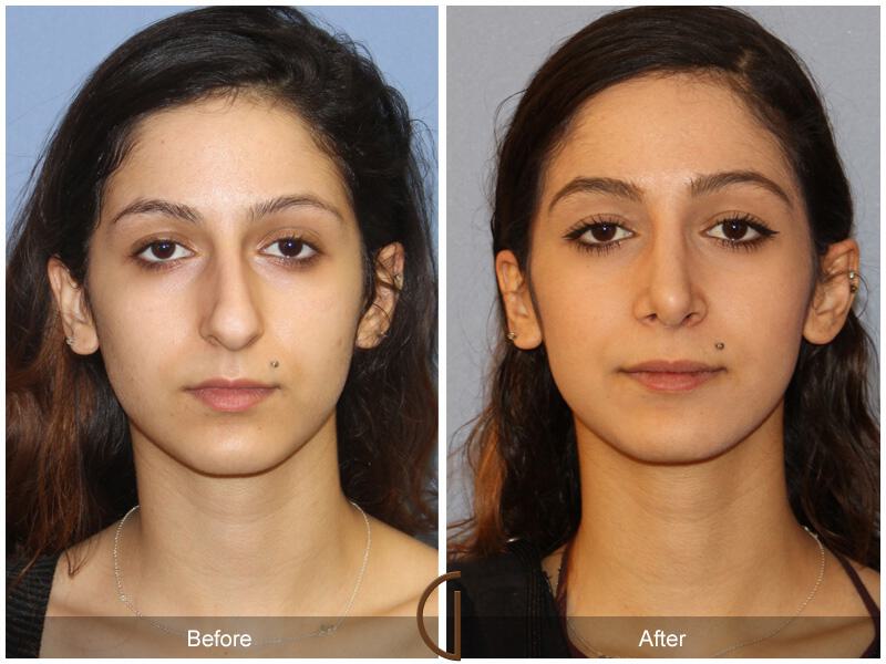 Female Rhinoplasty Before & After Photo