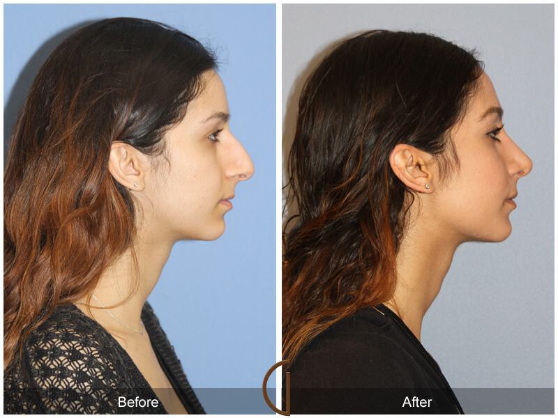 Female Rhinoplasty Before & After Photo