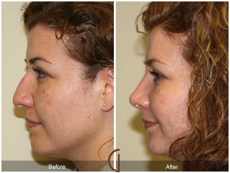 Female Rhinoplasty Before & After Photo