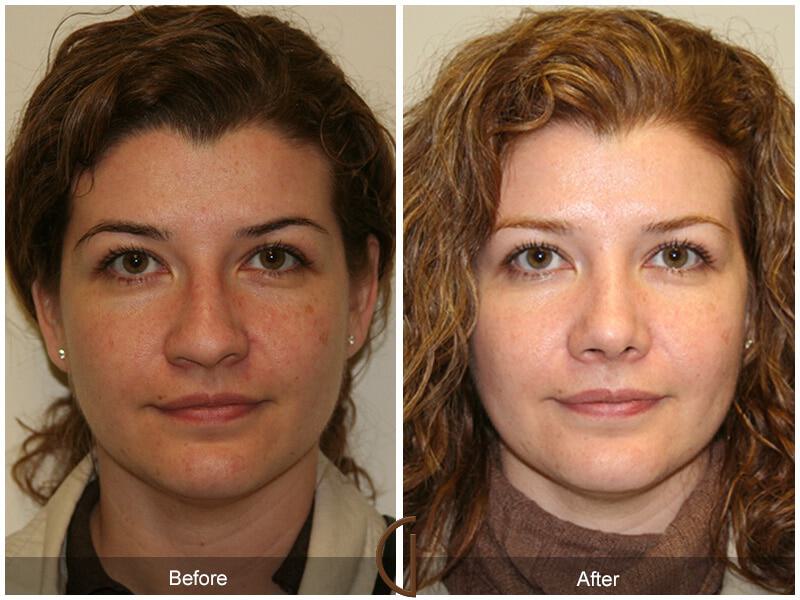 Female Rhinoplasty Before & After Photo