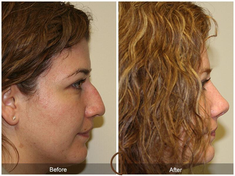 Female Rhinoplasty Before & After Photo