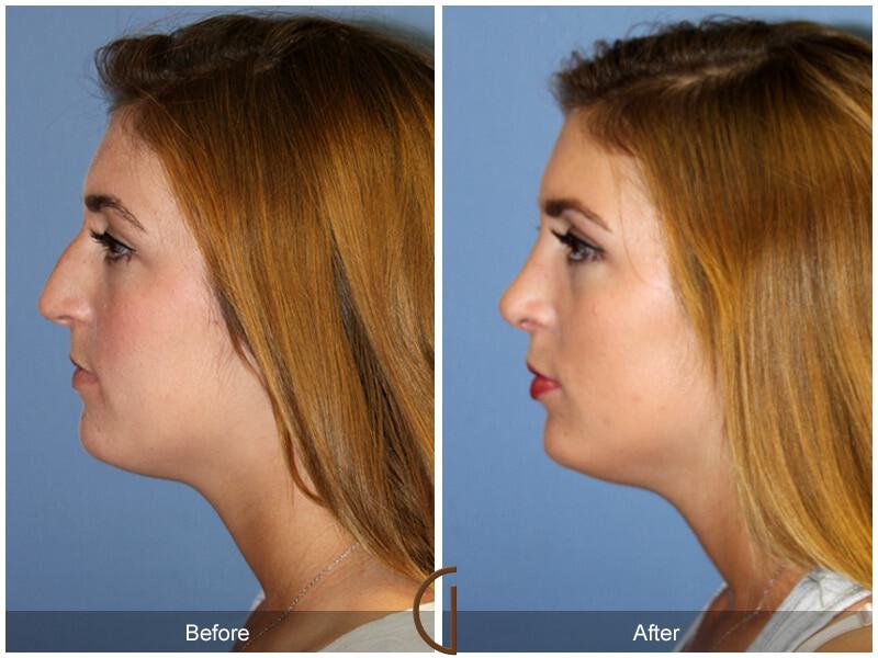 Female Rhinoplasty Before & After Photo