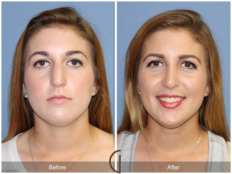 Female Rhinoplasty Before & After Photo