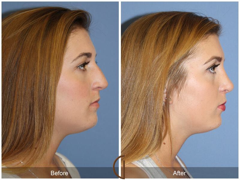 Female Rhinoplasty Before & After Photo