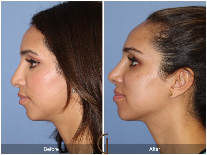 Female Rhinoplasty Before & After Photo