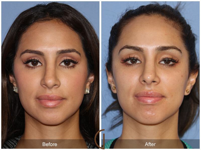 Female Rhinoplasty Before & After Photo