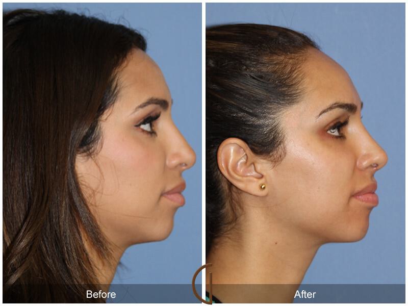 Female Rhinoplasty Before & After Photo