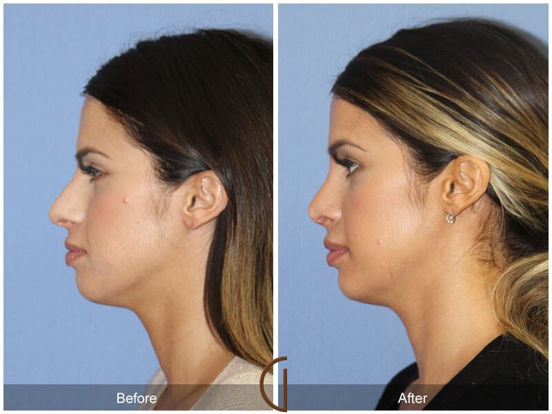 Female Rhinoplasty Before & After Photo