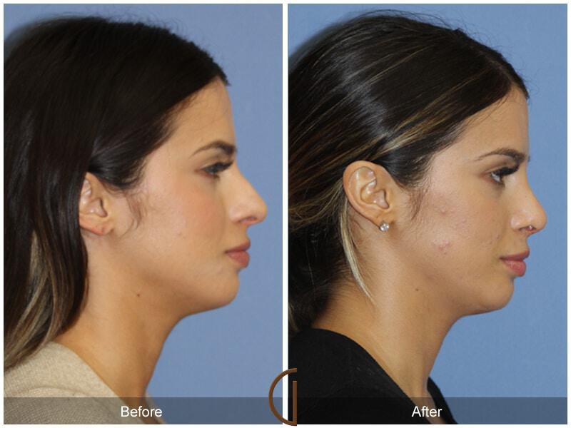 Female Rhinoplasty Before & After Photo