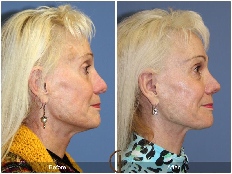 Female Rhinoplasty Before & After Photo