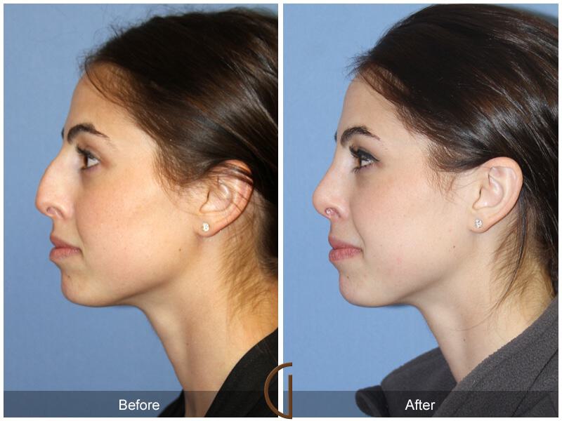 Female Rhinoplasty Before & After Photo