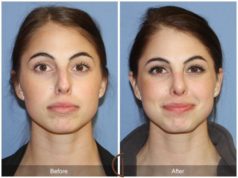 Female Rhinoplasty Before & After Photo