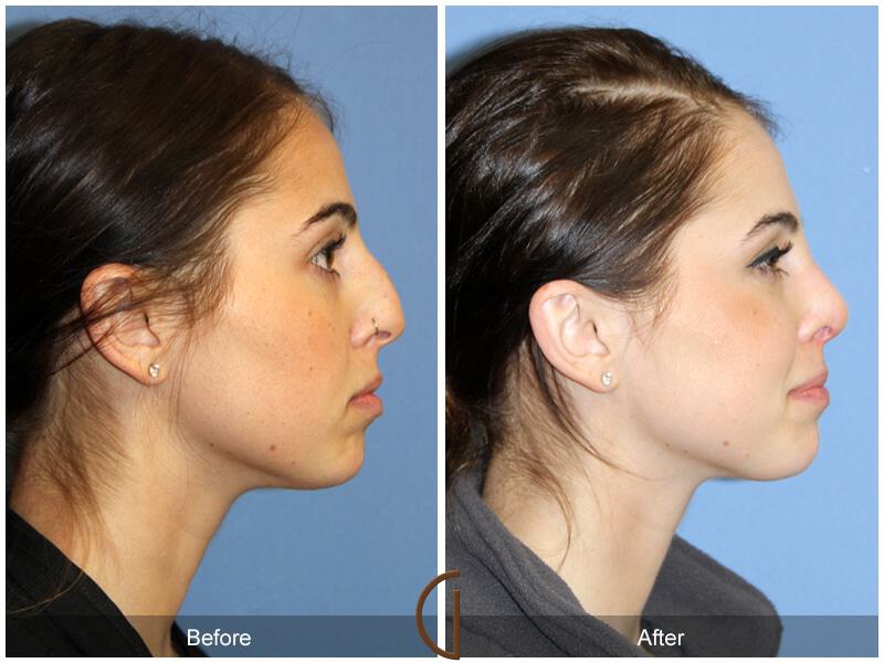 Female Rhinoplasty Before & After Photo