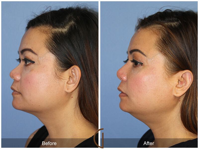 Female Rhinoplasty Before & After Photo